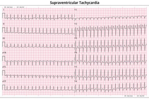 Supraventricular Tachycardia Symptoms Causes And Management