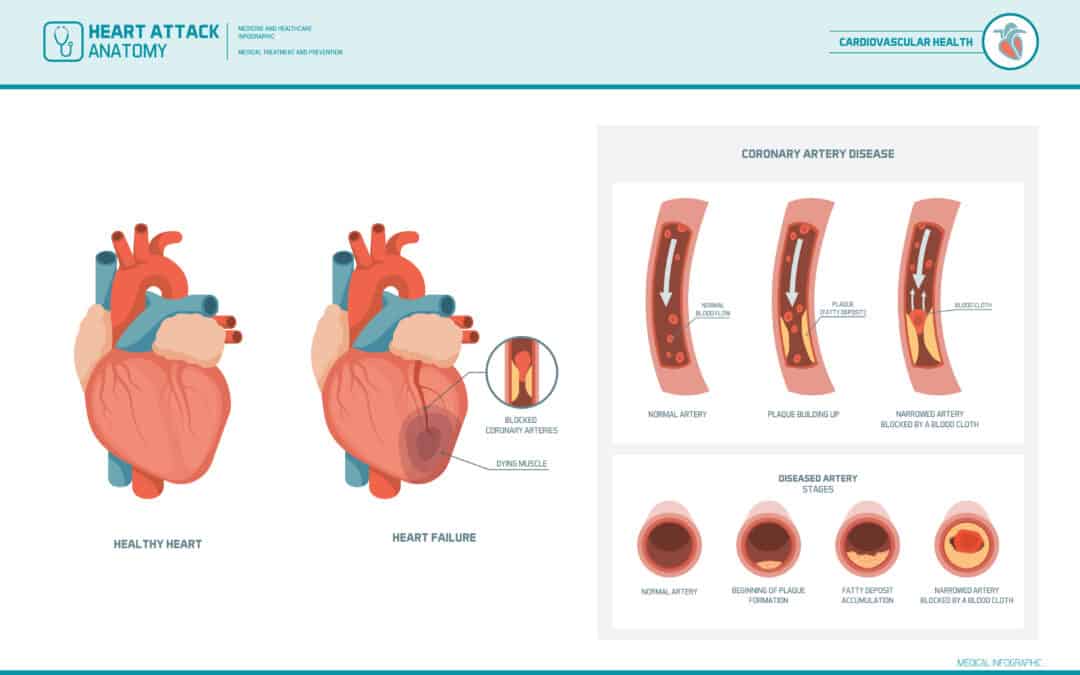 Coronary Artery Disease: A Deep Dive into Causes and Treatments