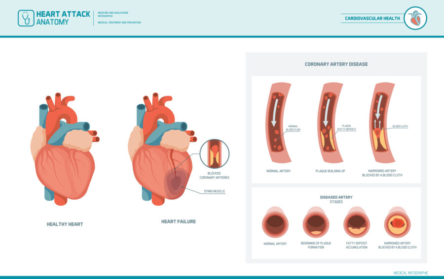 llustration showing acute heart failure. Plaque build-up in the