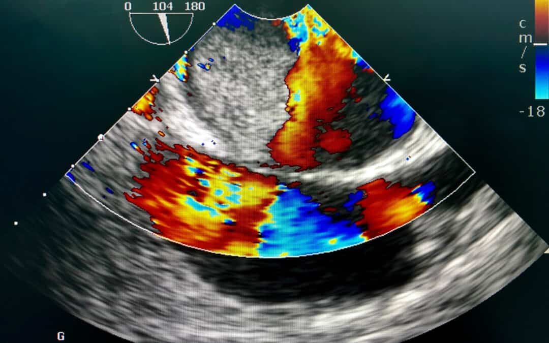 A Patient’s Guide to Transesophageal Echocardiogram