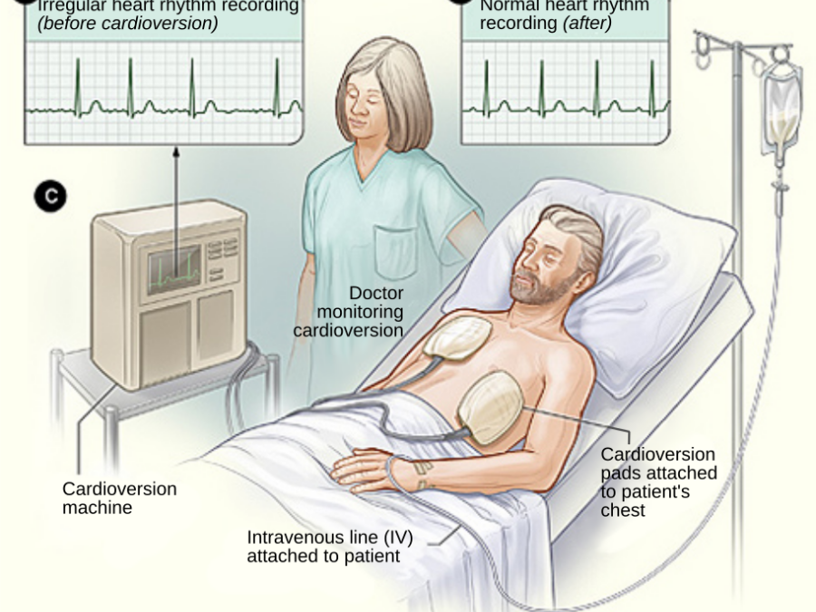 Cardioversion: A Lifesaver for Heart Rhythm Disorders