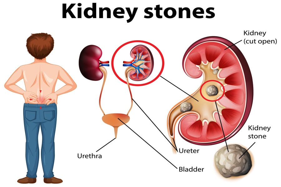 Chronic Kidney Disease: An In-depth Analysis