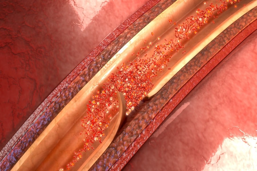 Spontaneous Coronary Artery Dissection (SCAD): A Hidden Threat to Heart Health