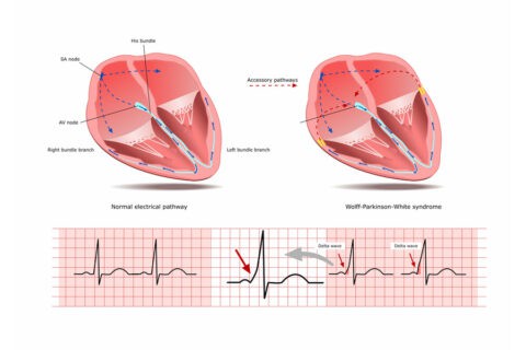 Wolff-Parkinson-White Syndrome | Longmore Clinic