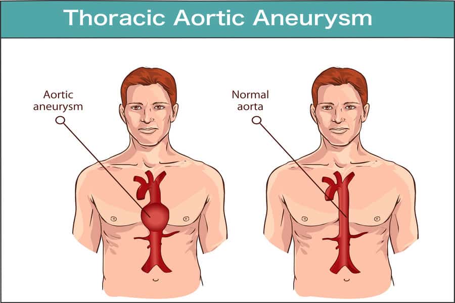 Aortic Aneurysm A Comprehensive Overview