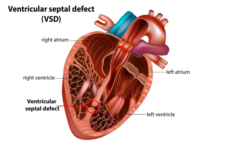 Understanding Ventricular Septal Defect: Causes, Symptoms, and Management