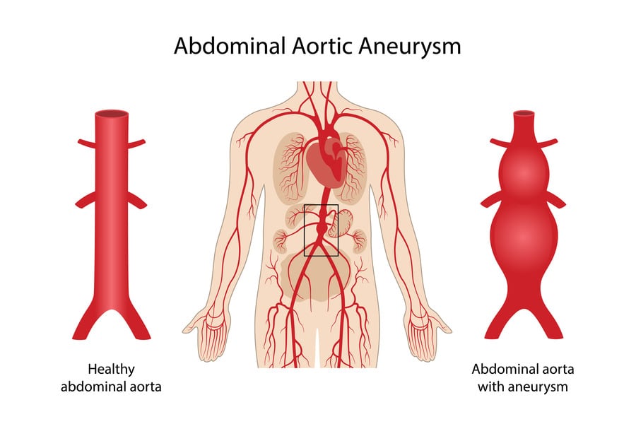 Abdominal Aortic Aneurysm: Causes, Symptoms, and Treatment
