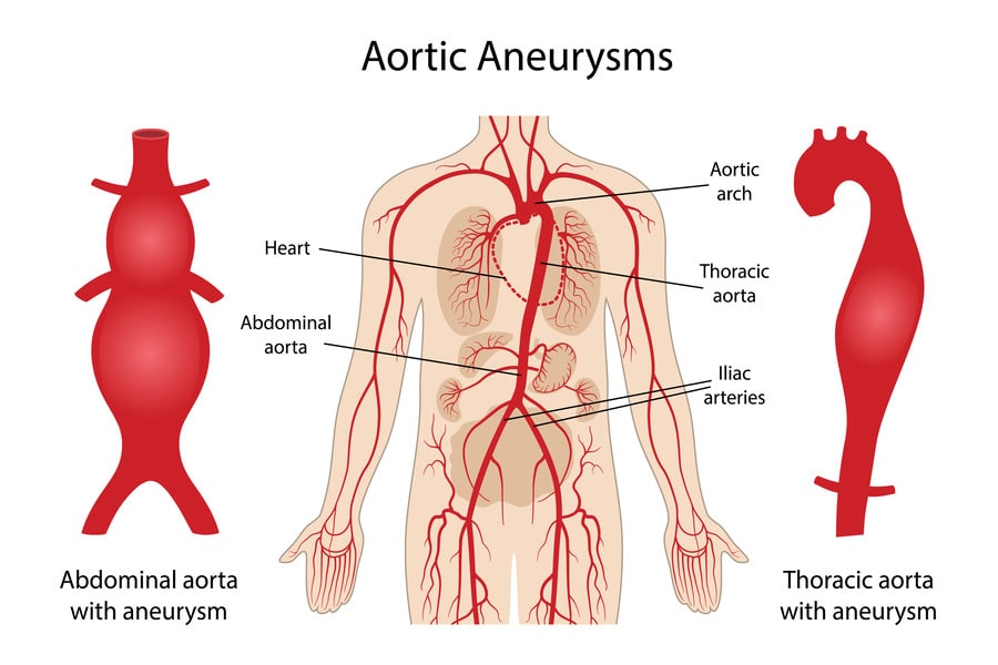 Thoracic Aortic Aneurysm: Causes, Symptoms, and Treatment