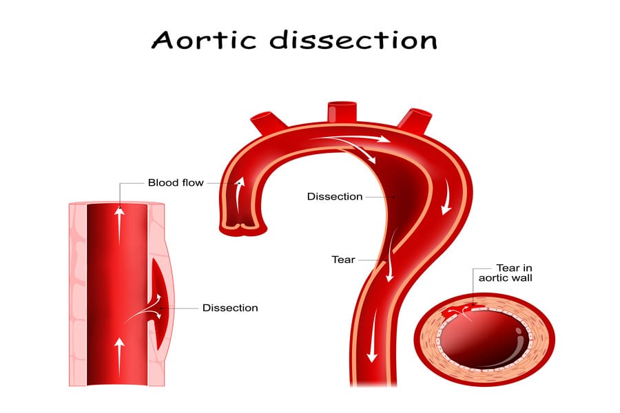 Aortic Dissection: A Lifesaving Guide