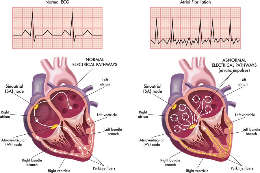 Atrial Fibrillation: Causes, Symptoms, and Advanced Treatments