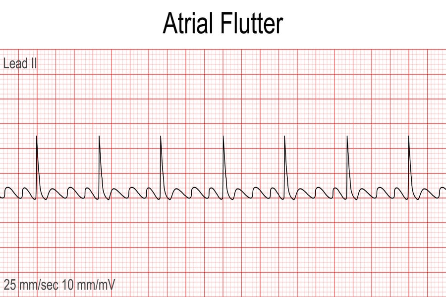 Atrial Flutter: An In-Depth Exploration of a Heart Rhythm Disorder