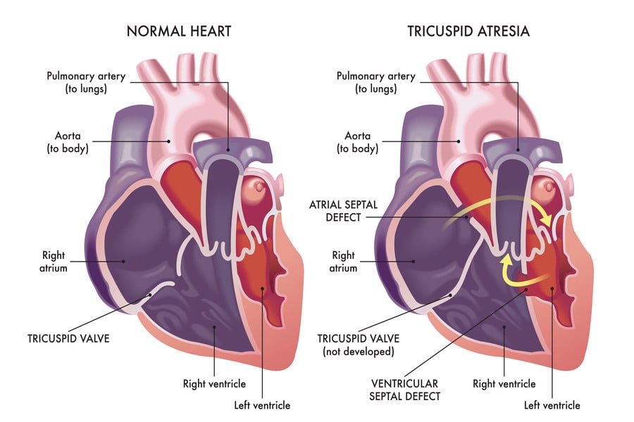 Tricuspid Atresia: Understanding a Congenital Heart Condition