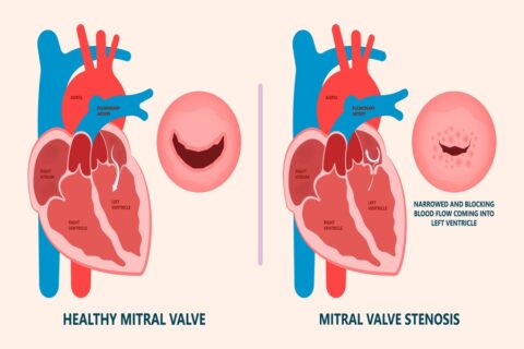 Mitral Valve Stenosis - Longmore Clinic