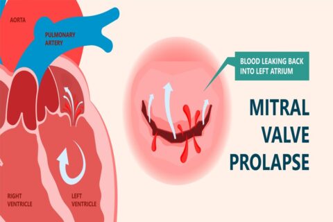 Understanding Mitral Valve Prolapse - Longmore Clinic