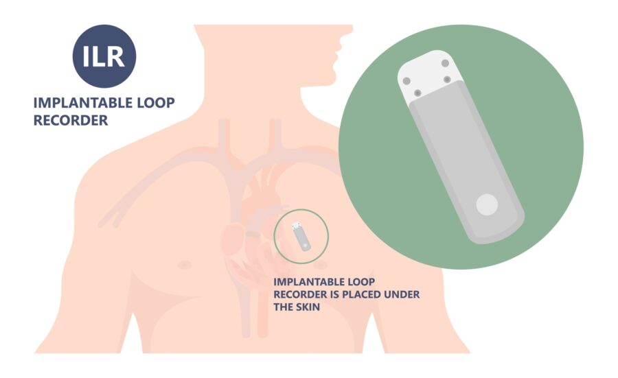 Decoding Implantable Loop Recorders A Comprehensive Guide