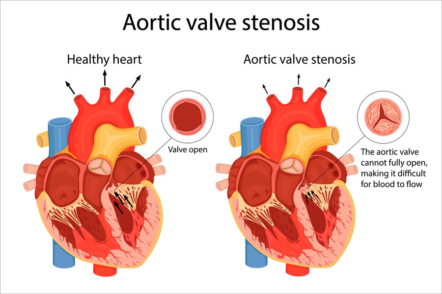 Aortic Valve Stenosis: A Deep Dive into the Silent Heart Condition