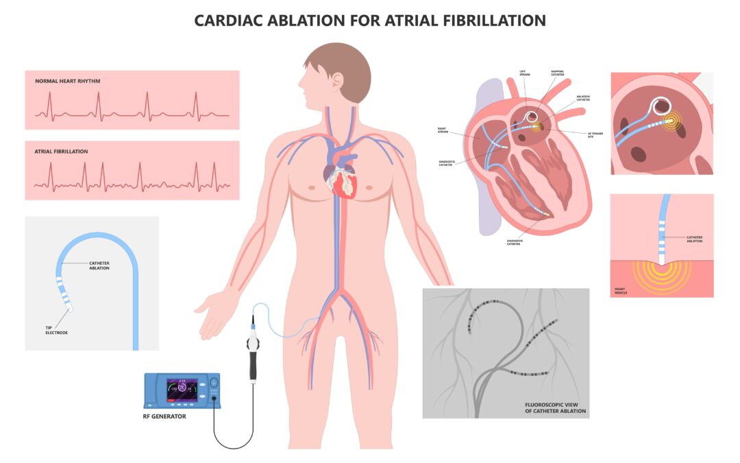 Journey Through Cardiac Ablation: Understanding Cardiac Ablation