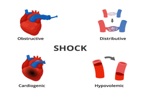 Cardiogenic Shock: A Comprehensive Overview - Longmore Clinic