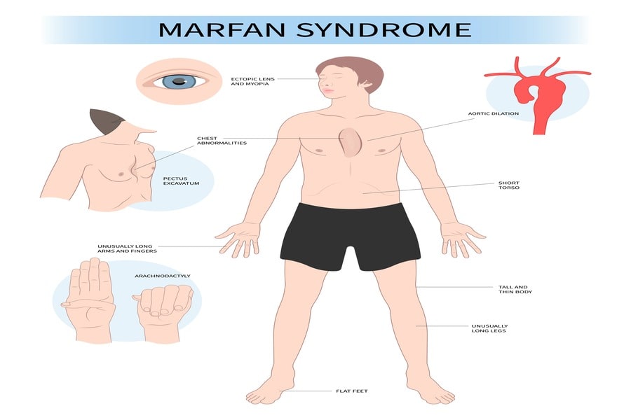 Marfan Syndrome Disease Neonatal Marfan Syndrome GRFZ Marfan Syndrome Disease Neonatal Marfan Syndrome GRFZ