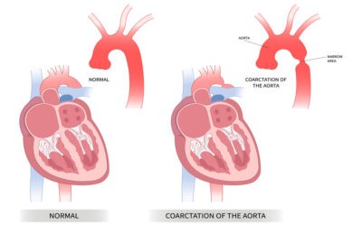 Coarctation of the Aorta: A Comprehensive Guide