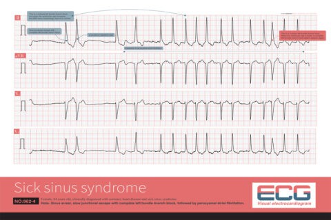 Sick Sinus Syndrome: Causes, Symptoms, and Treatment Options