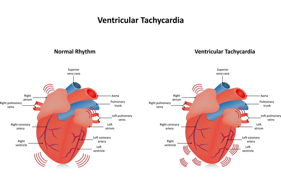 Ventricular Tachycardia: Symptoms, Causes, and Management