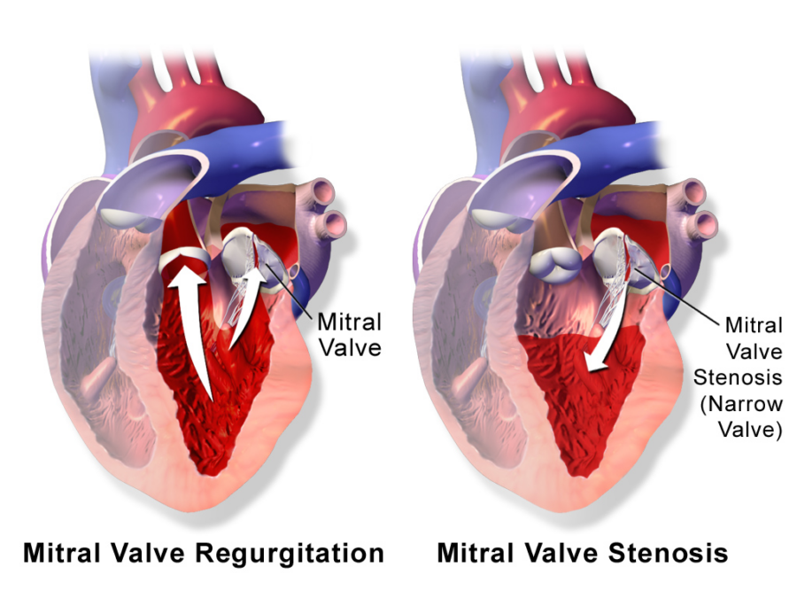 Mitral valve regurgitation