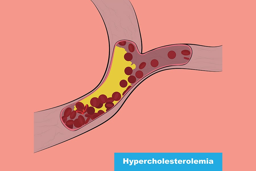 Familial Hypercholesterolemia: A Comprehensive Insight